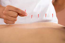Dry Needling in the Physical Therapy Setting